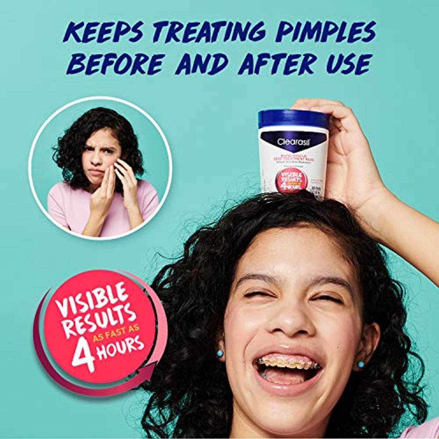 Acne Treatment Facial Cleansing Pads- Clearasil Rapid Rescue Deep Treatment Pads with Salicylic Acid Acne Medication, 90 Count (Pack of 6)
