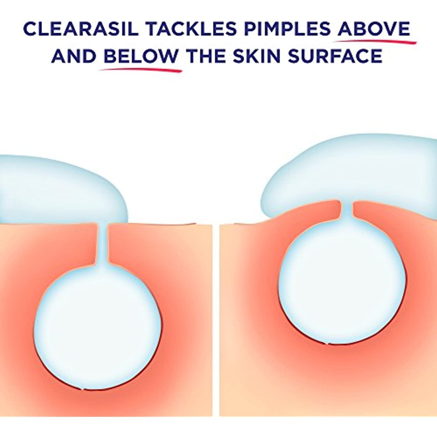 Clearasil Rapid Rescue, Deep Treatment Wash 6.78 oz (Pack of 3) EXP 12/22